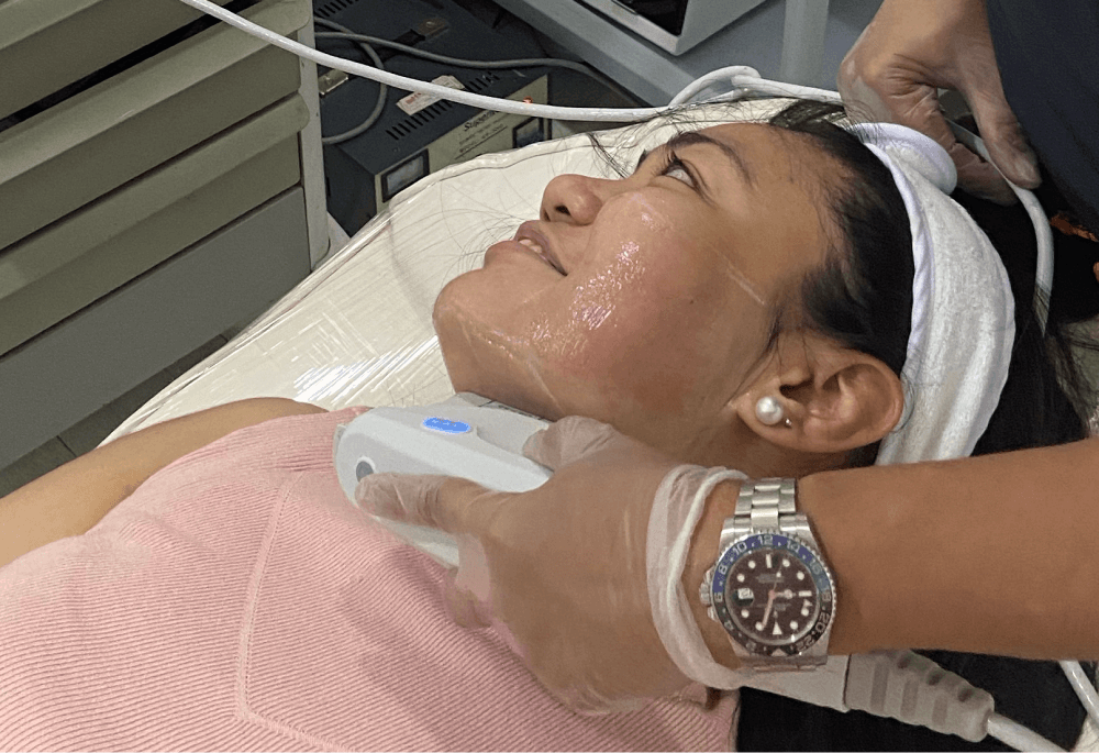 MFU-V treatment to lift and tighten my jawline