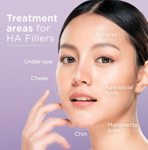 Treatment areas for HA Fillers 