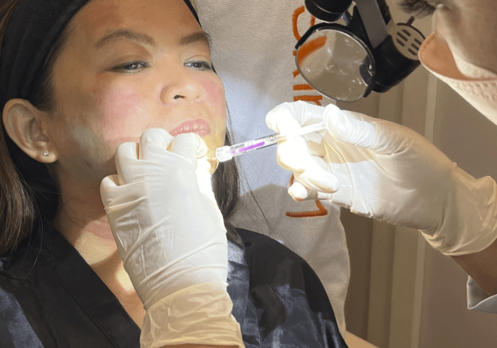 Hyaluronic acid fillers injected for a more projected chin